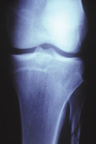 Il vit pendant 50 ans avec une jambe cass�e !