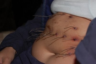 Une femme pr�tend que des fils de fer sortiraient de son corps ! 